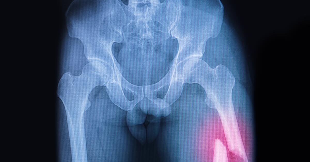 Fractured Femur Symptoms Causes Treatments
