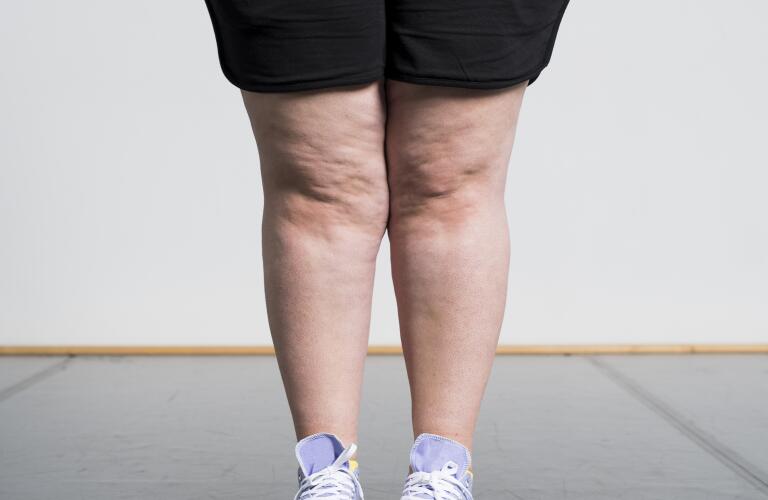 Understanding Hidradenitis Suppurativa Of The Groin