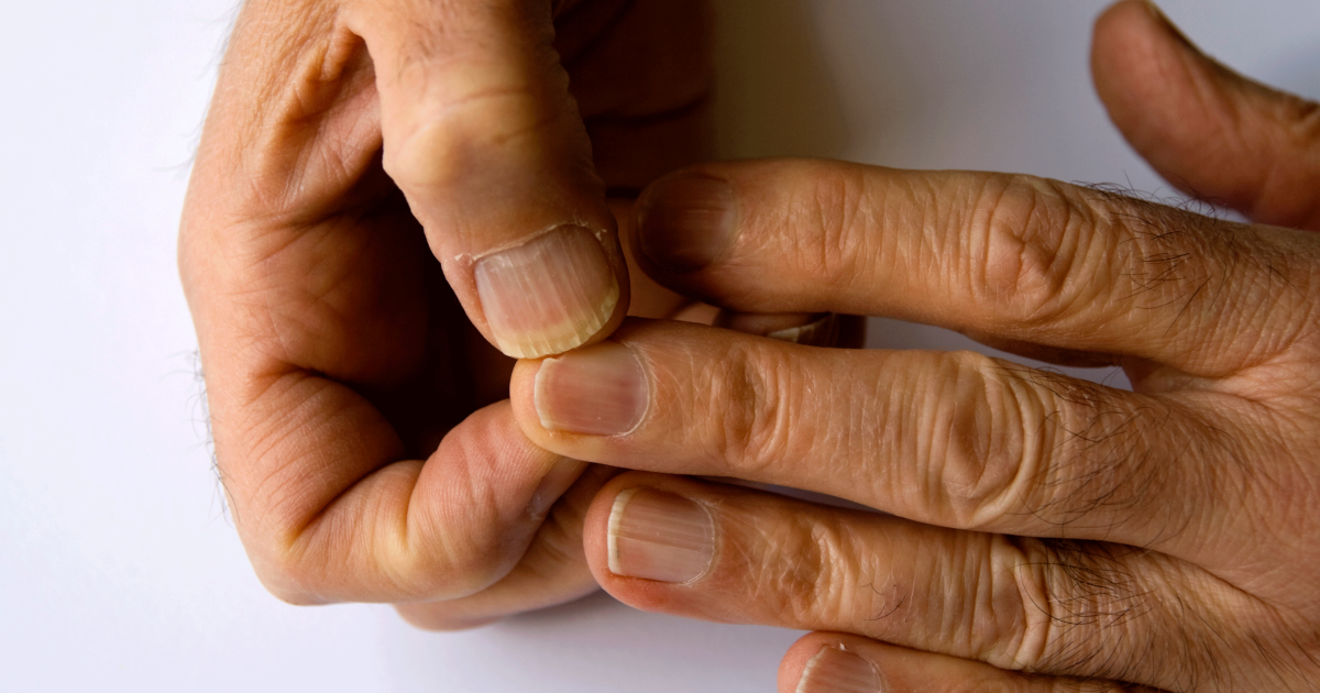 Nail Ridges Symptoms Causes Treatments