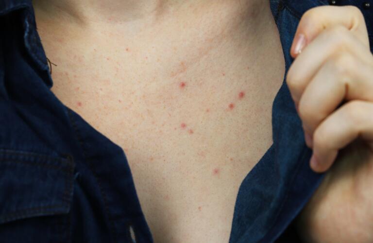 Chest Acne Symptoms Risk Factors Treatment