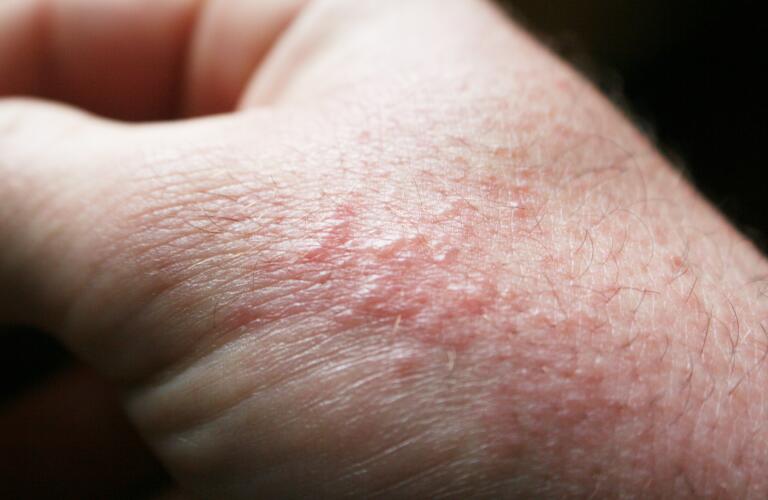 Poison oak rash symptoms treatment pictures