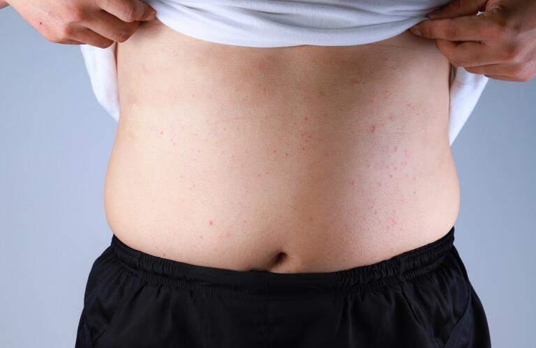 Stomach Rash Symptoms Causes Treatment Stomach Rash Itchy Vs Not Itchy