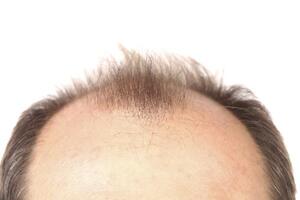 Male Pattern Baldness Treatment Options Lllt For Hair Loss In