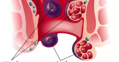 before and after stapled hemorrhoidectomy before and after stapled hemorrhoidectomy