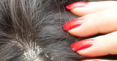 10 Things To Know About Head Lice Healthgrades Com