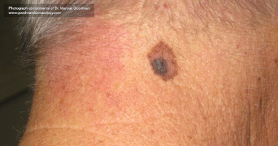 What Does Skin Cancer Look Like? | Healthgrades.com