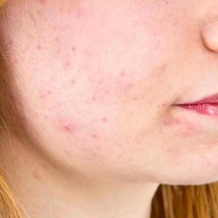 Cheek Rash Healthgrades Com