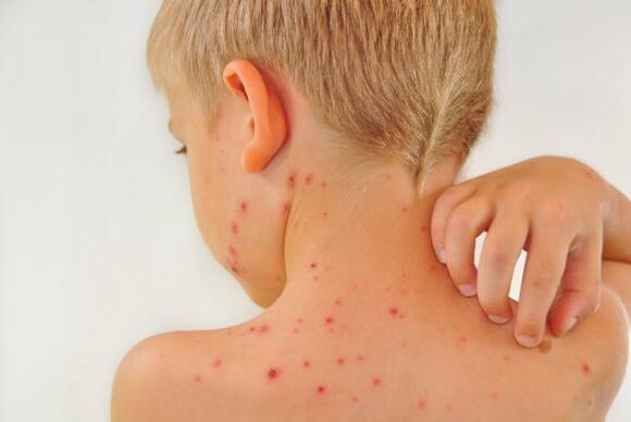 12 Things to Know About Shingles