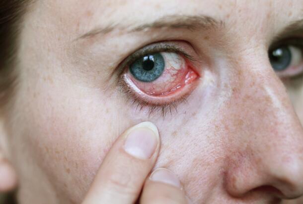 eye-herpes-symptoms-causes-treatments-healthgrades