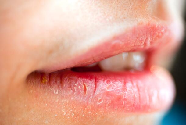 what does severe dry lips mean