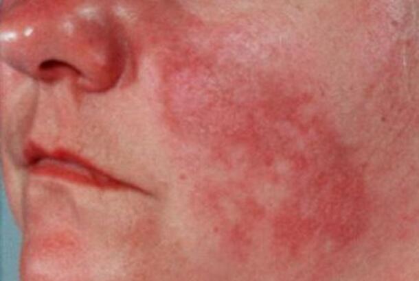 butterfly-rash-healthgrades